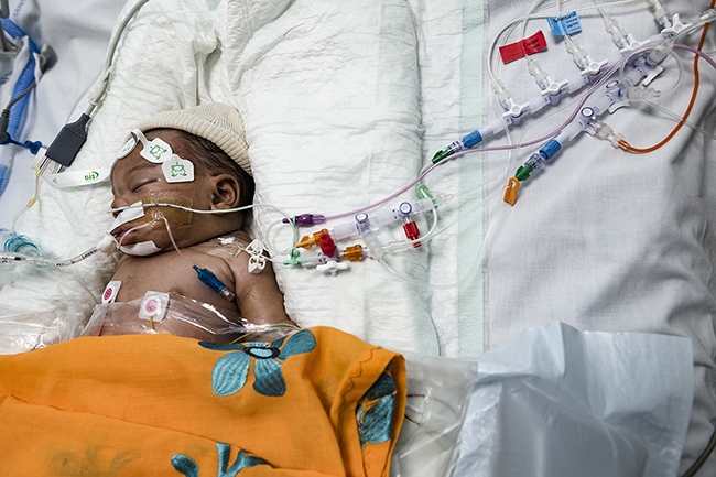 Newborn in complex intensive care due to a severe bronchiolitis. Mayotte - 2021